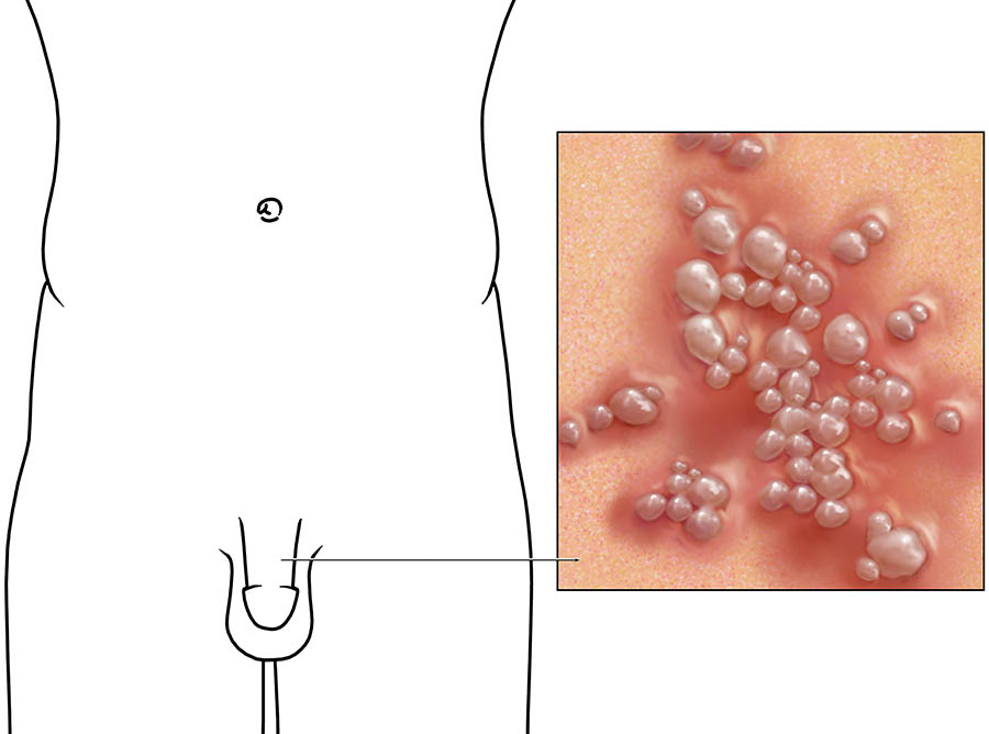 How To Identify And Treat Herpes Symptoms Men? Answered