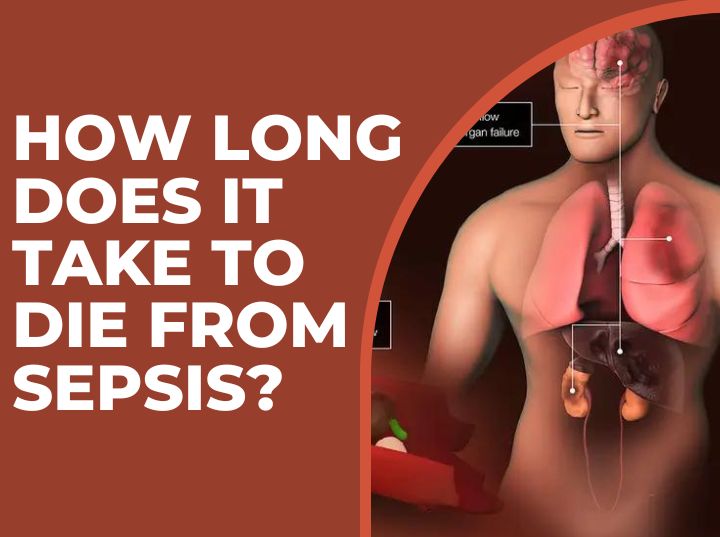 How Long Does It Take to Die from Sepsis?